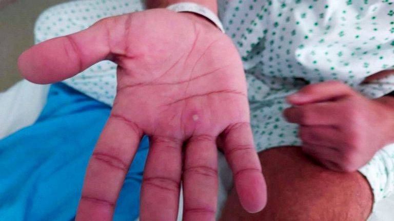 ما يجب أن يعرفه الآباء..جدري القرود يصيب الأطفال أيضا