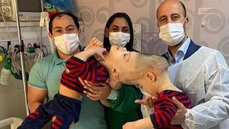 فصل توأم برازيلي ملتصق في الرأس _ صور