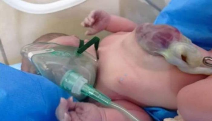 ولادة طفلة بقلب خارج القفص الصدري في العراق