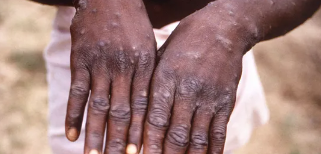 منظمة الصحة تطلب اقتراح أسماء بديلة لجدري القردة