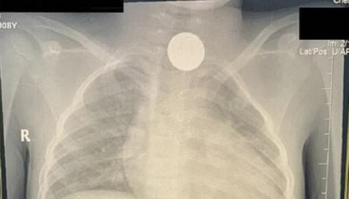 السعودية..عملة معدنية ظلت عالقة بمريء طفلة 4 سنوات.. اكتشفت بالصدفة