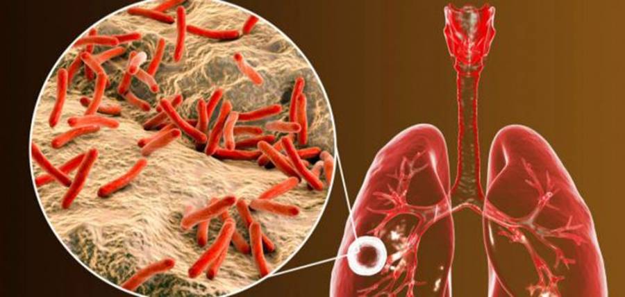 علاج جديد يطلق بداية نهاية مرض السل المقاوم للأدوية