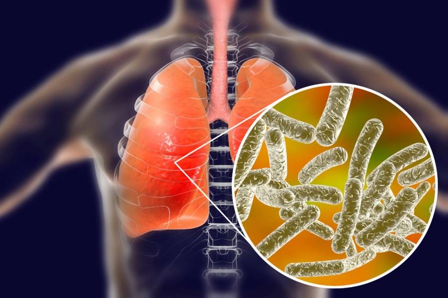 أودى بحياة 4 أشخاص في الأرجنتين.. ماذا تعرف عن داء الفيالقة؟