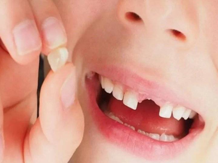 ما تفسير حلم خلع الضرس والاسنان فى المنام بمختلف التفسيرات