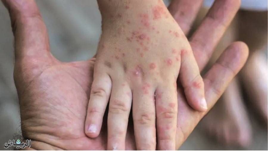 البحرين تسجّل أول إصابة بجدري القرود