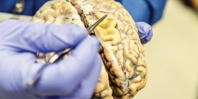 دراسة: باحثون يكتشفون جزيئاً في الدماغ يساعد على مكافحة الزهايمر