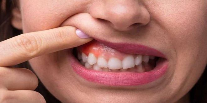 باحثون في معهد كارولنسكا بالسويد يحددون البكتيريا الأكثر شيوعاً في التهابات الفم الشديدة