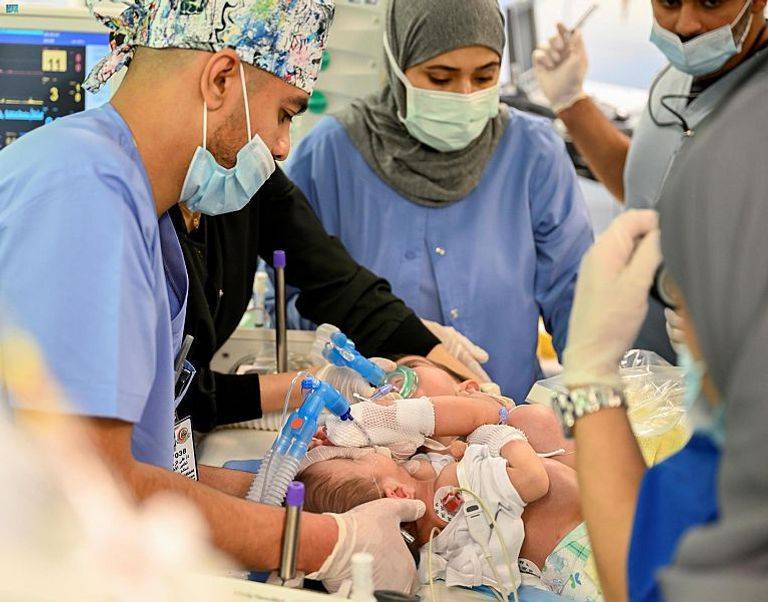 نجاح عملية فصل التوأم السيامي العراقي علي وعمر في السعودية _صور