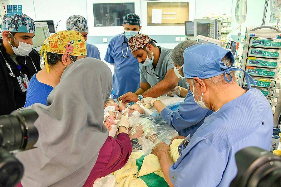 54 عملية ناجحة من 23 دولة في 3 قارات لفصل التوائم السامية في السعودية