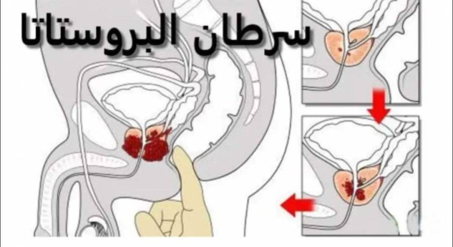 اختبار دم جديد يكشف عن سرطان البروستاتا بدقة 92