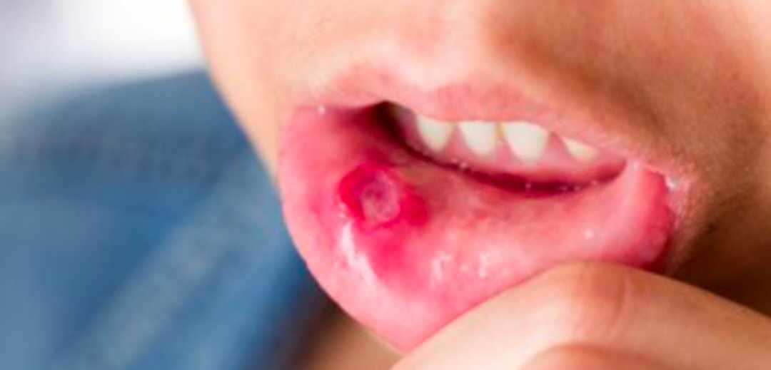 أسباب ظهور الحمو وطرق علاجه