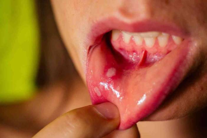 هل تفيد الوسائل الشعبية في علاج التهابات الفم؟