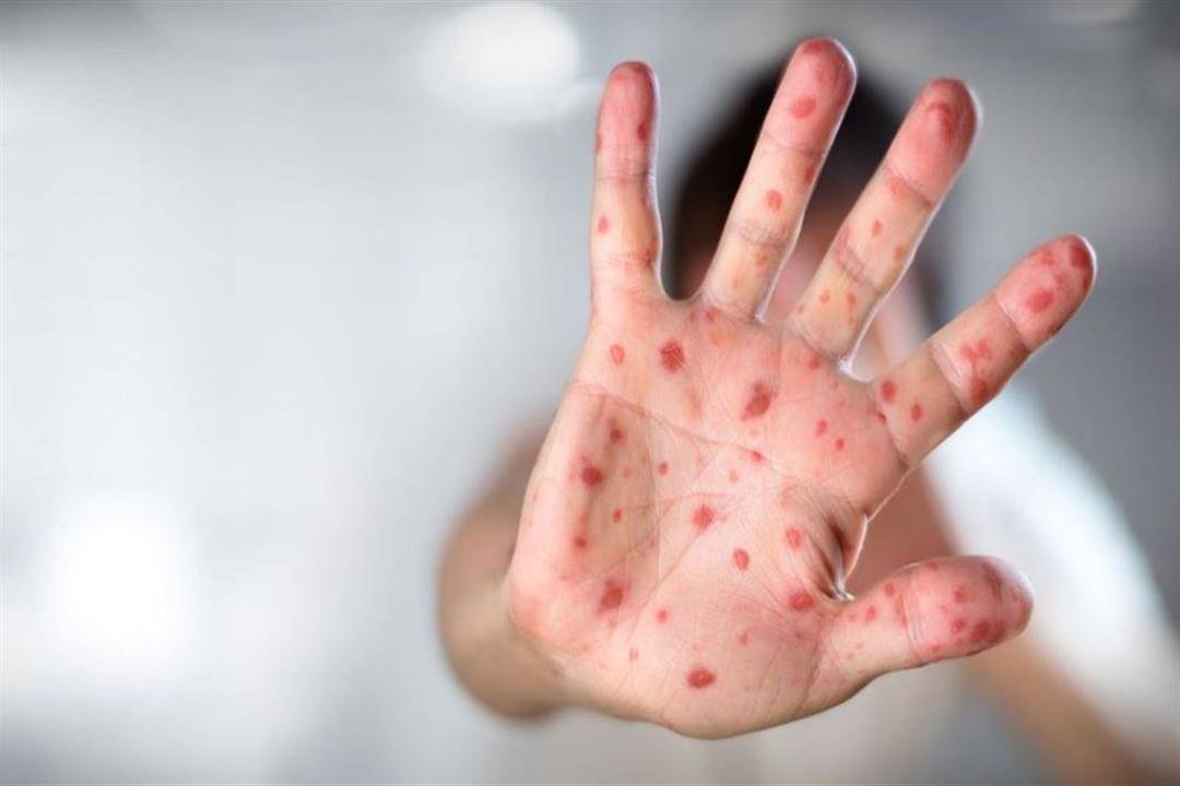 اشتباه بإصابة 10 أشخاص من عائلة واحدة بالحصبة في المفرق