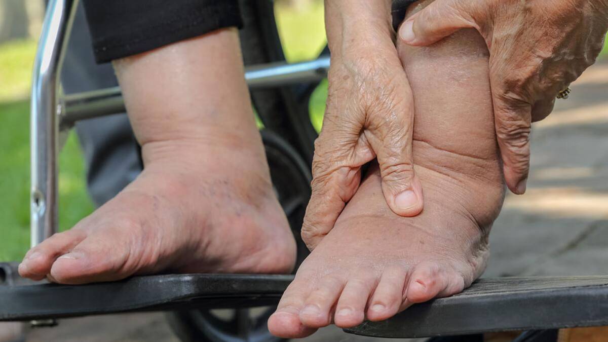 ماذا تعرف عن الوذمة ؟