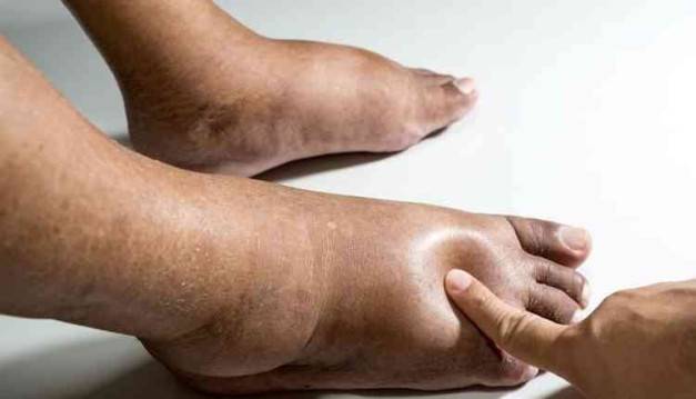 الوذمة.. مؤشر كبير على أمراض خطيرة