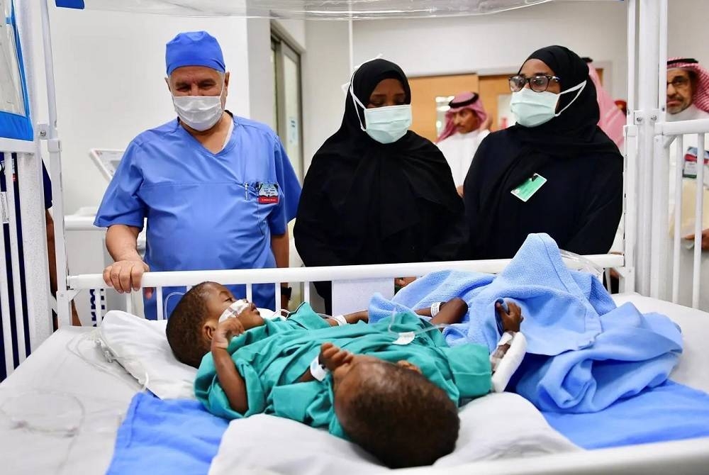 السعودية ...بدء عملية فصل التوأم السيامي التنزاني «حسن وحسين»