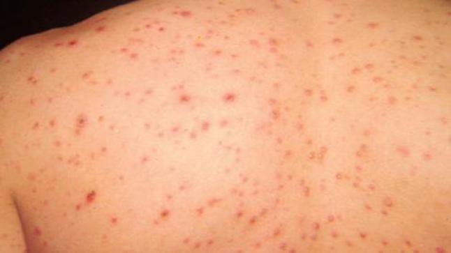 خوري تدعو للتعامل بجدية مع مرض الحصبة.. من أخطر الفيروسات