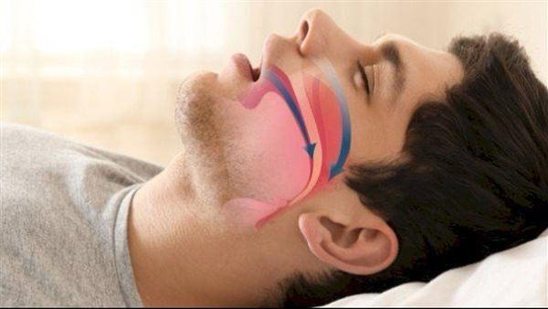 الدكتور الطراونة يكشف مخاطر توقف التنفس أثناء النوم
