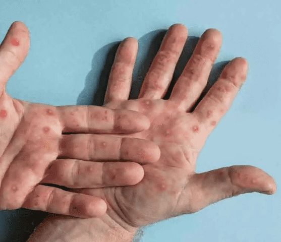 الأردن.. لا حالات إيجابية بين مخالطي مصاب جدري القرود
