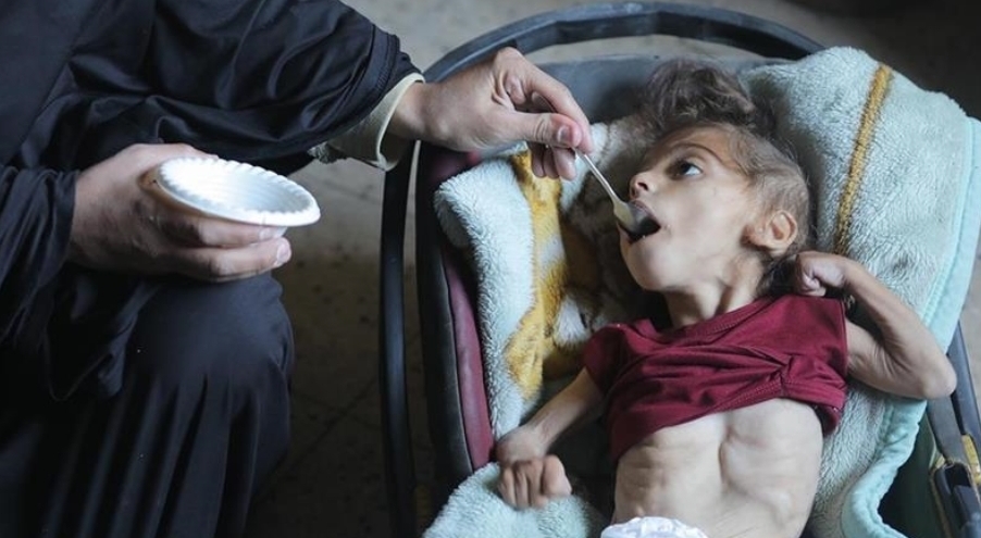 “أونروا”: 66 ألف طفل في قطاع غزة يعانون سوء تغذية خطيرا