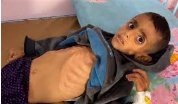 900 ألف طفل في غزة يعانون من الجوع