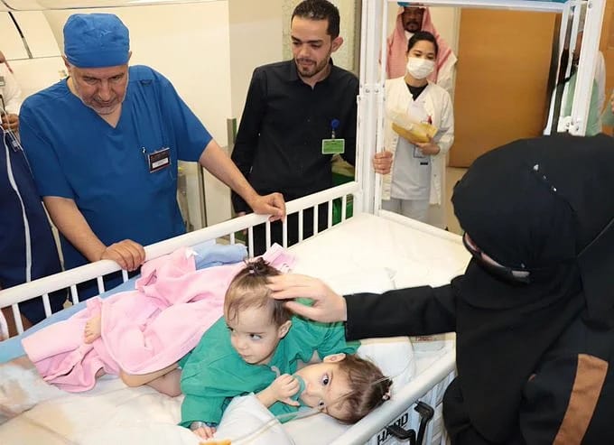 انطلاق عملية فصل التوأم السيامي السوري سيلين وإيلين بالسعودية