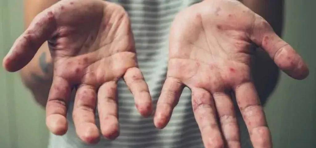 منظمة الصحة العالمية تحذر.. تفشي جدري القرود في 11 دولة أفريقية وانتشار عالمي مقلق