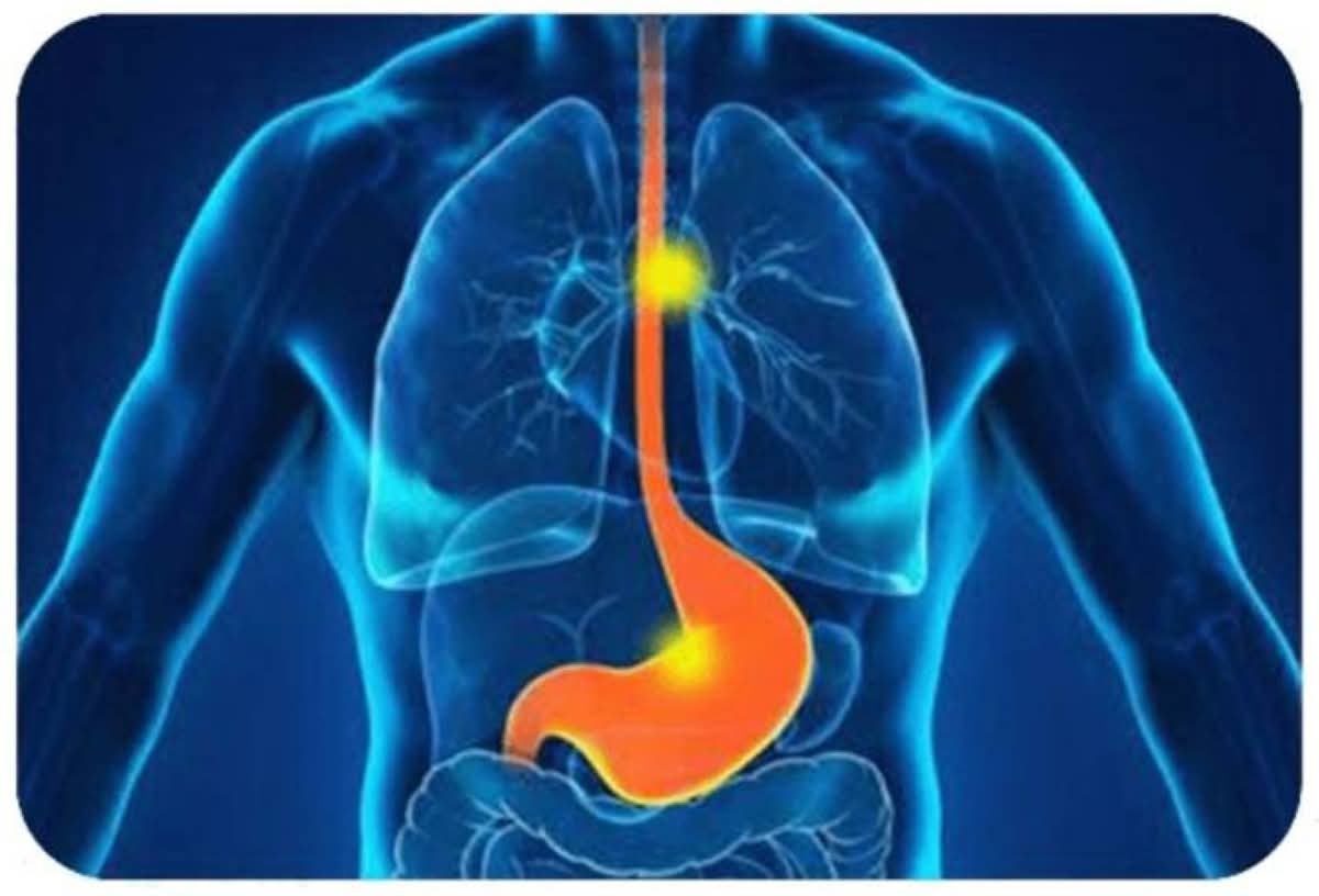 علماء يطورون كبسولة للكشف المبكر عن سرطان المريء