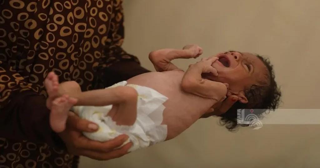 تصاعد وفيات التجويع في غزة… 227 ضحية بينهم 103 أطفال