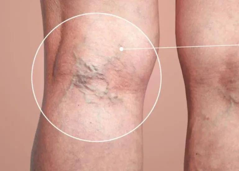 دوالي الأوردة.. الأسباب والأعراض وطرق العلاج المنزلي