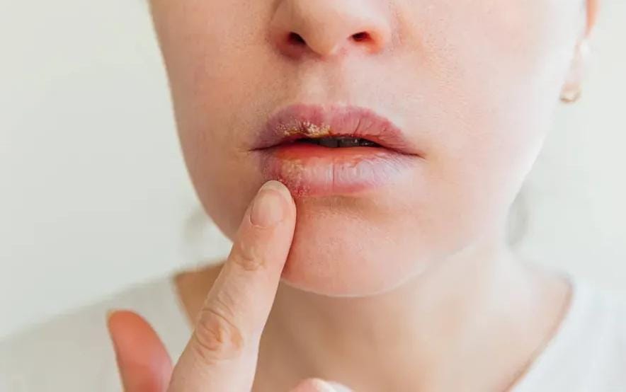 لقاح محتمل من الألبكة؟.. اكتشاف مذهل قد ينهي معاناة ملايين المرضى