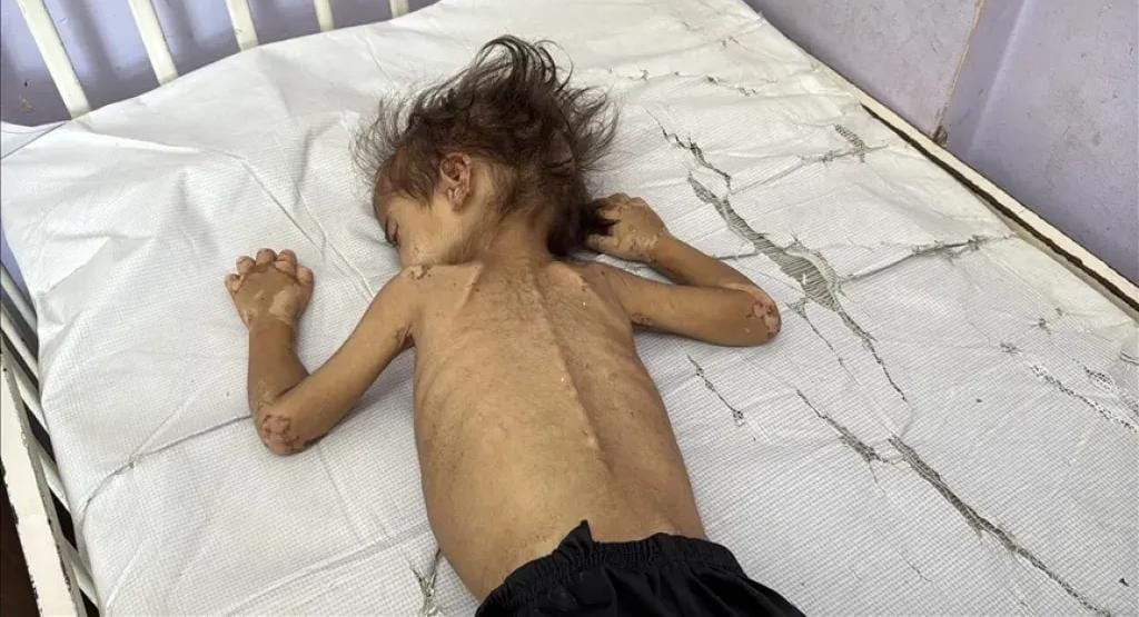 تجويع غزة.. حصيلة وفيات المجاعة ترتفع إلى 404 أشخاص، بينهم 141 طفلاً