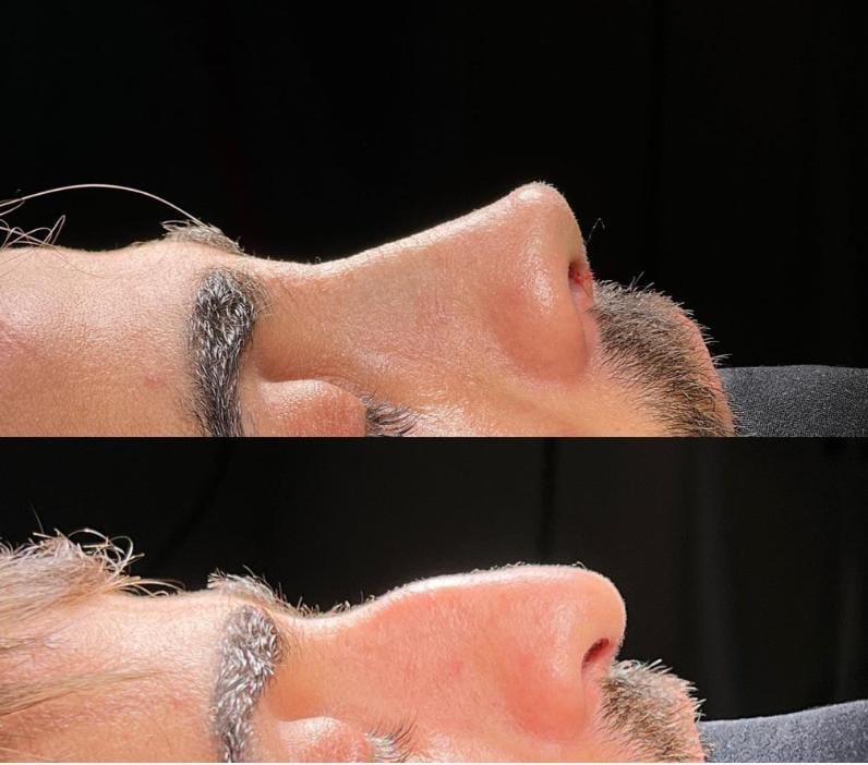 عملية تجميل الوجه مع دكتور ساري رباح