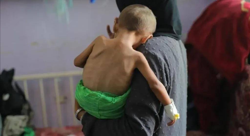 ارتفاع وفيات التجويع في غزة إلى 422 بينهم 145 طفلًا