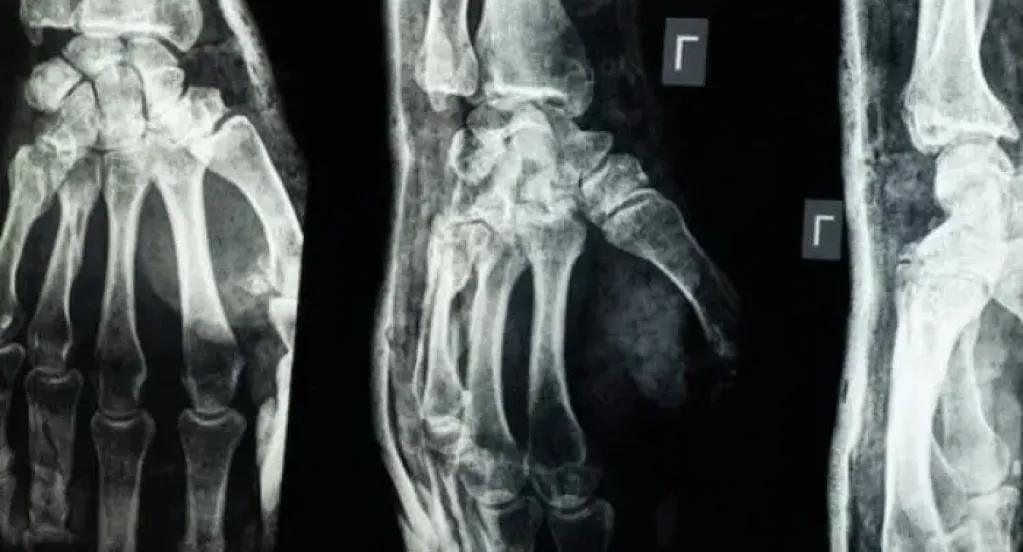 اكتشاف علمي رهيب.. الصين تبتكر ”غراء عظمي” يعالج الكسور خلال 3 دقايق فقط!