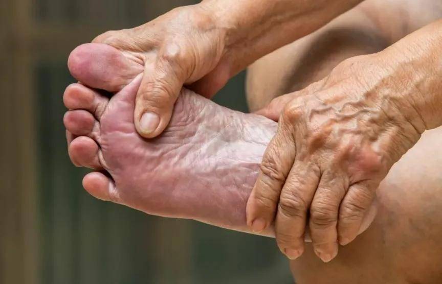 مرض الشرايين المحيطية.. علامات مبكرة تكشف انسداد الشرايين في الساقين