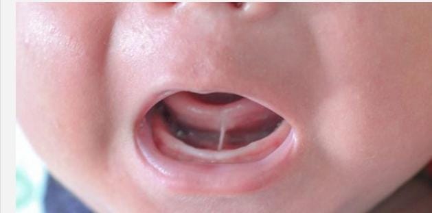 التصاق اللسان عند الرضع.. الأعراض الأسباب وطرق العلاج