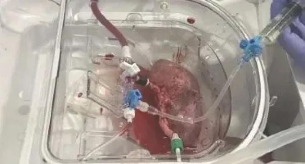 تقنية دمج كلية خنزير مع كلية بشرية تفتح آفاقًا جديدة لزراعة الأعضاء عالميًا 2025