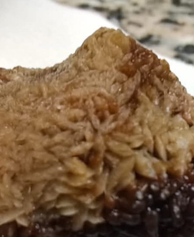 فريق طبي في مادبا ينجح في استخراج حصوة عملاقة من كلية مريض عبر عملية نوعية