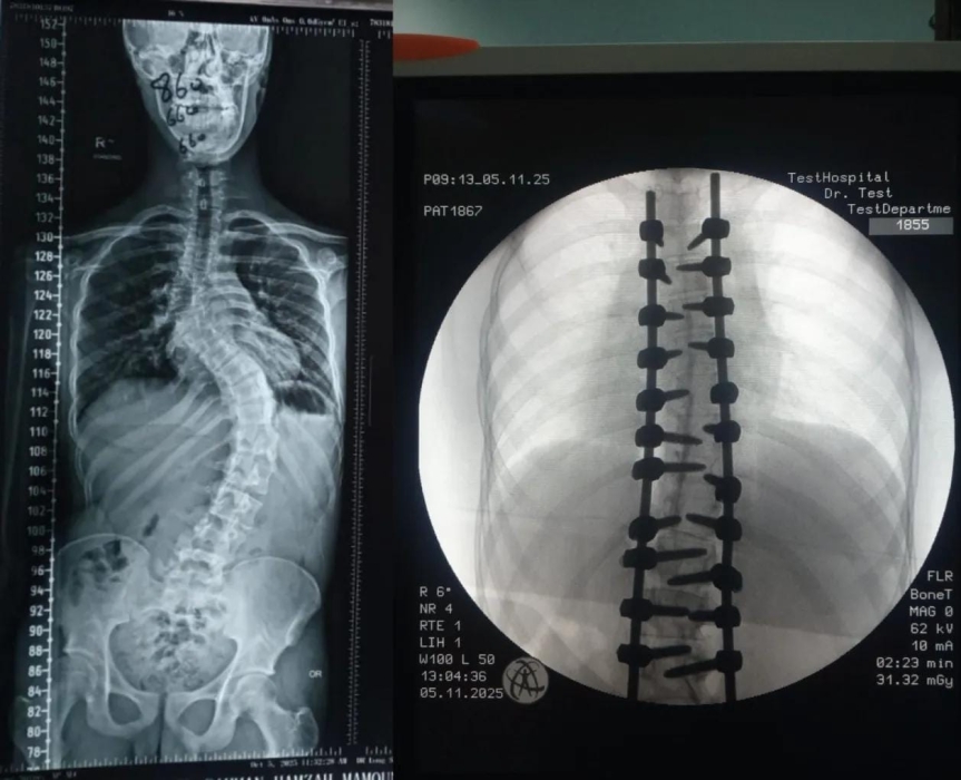 إنجاز طبي في مستشفى الأمير حمزة: تصحيح جنف حاد بالعمود الفقري