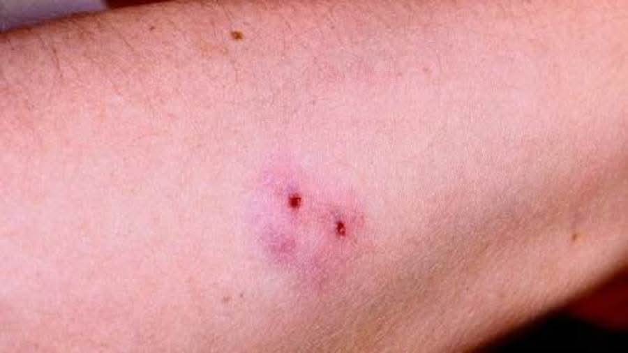 لقاحات كوفيد تفتح الباب أمام علاج ثوري لضحايا لدغات الثعابين