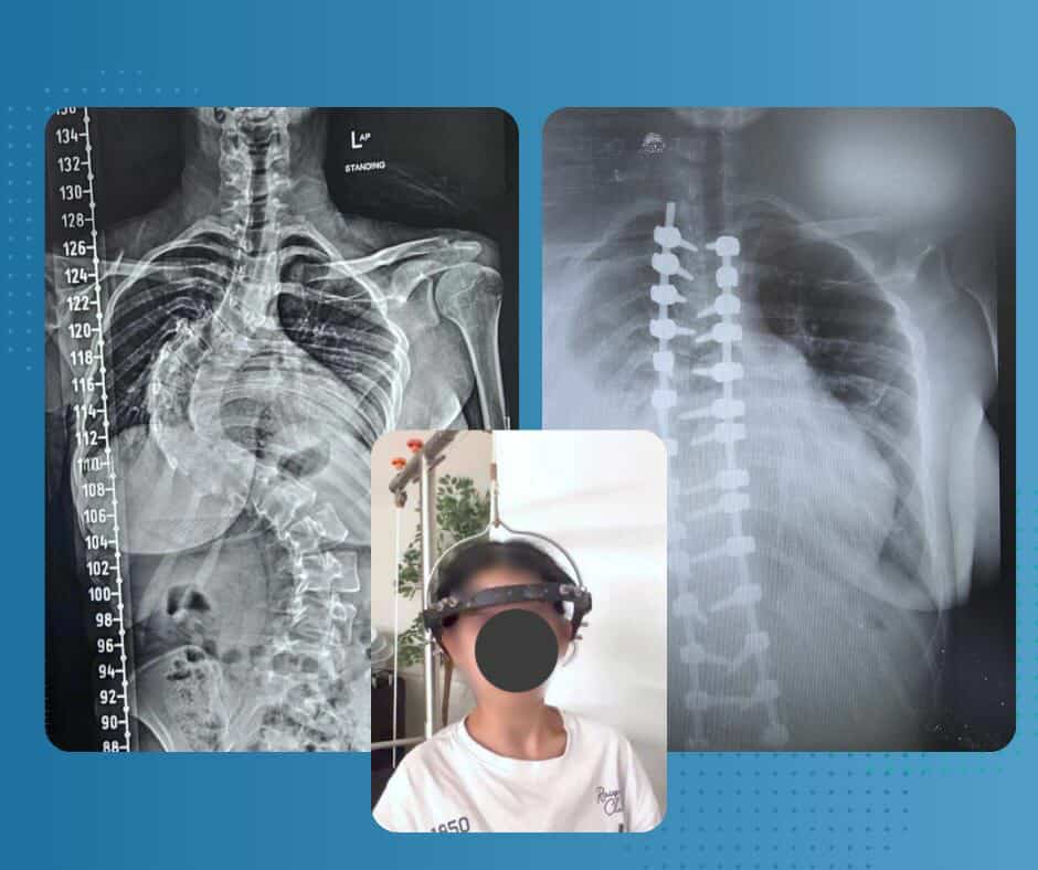 انجازا طبيا جديد في قسم جراحه العمود الفقري