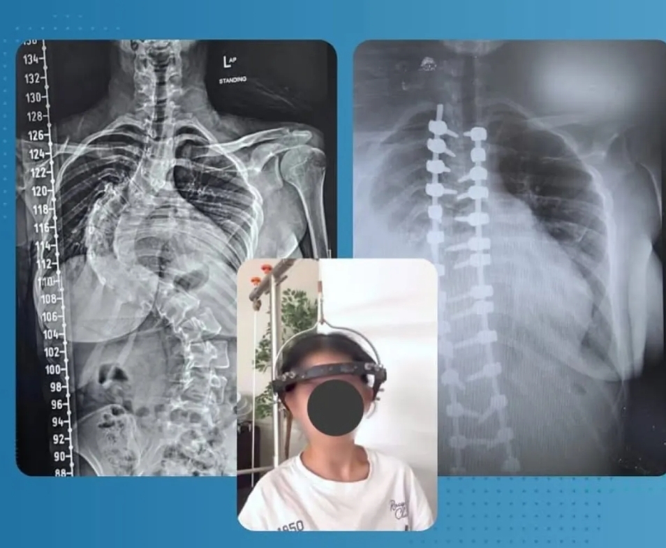 الأردن..إنجاز طبي جديد في جراحة العمود الفقري بمستشفى حمزة