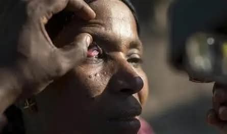 يسبب العمى .. مرض خطير يغزو اليمن والصحة العالمية تدق ناقوس الخطر