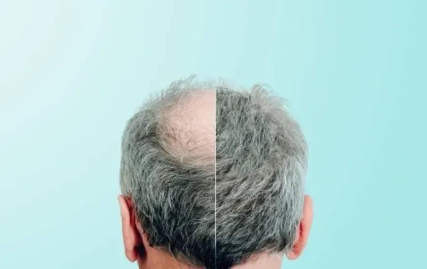 كلاسكوتيرون قد يصبح أول علاج مبتكر للصلع منذ 30 عاماً