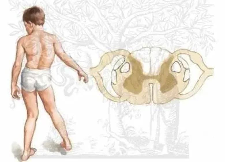 اكتشاف جيني جديد يغير مستقبل علاج ترنح فريدريك