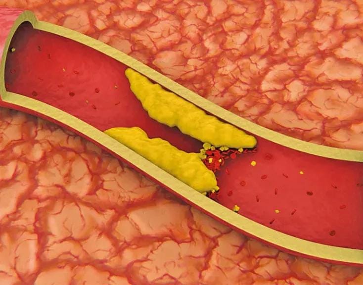 تحذير طبي .. علامات مبكرة لـ انسداد الشرايين اطلع على التفاصيل