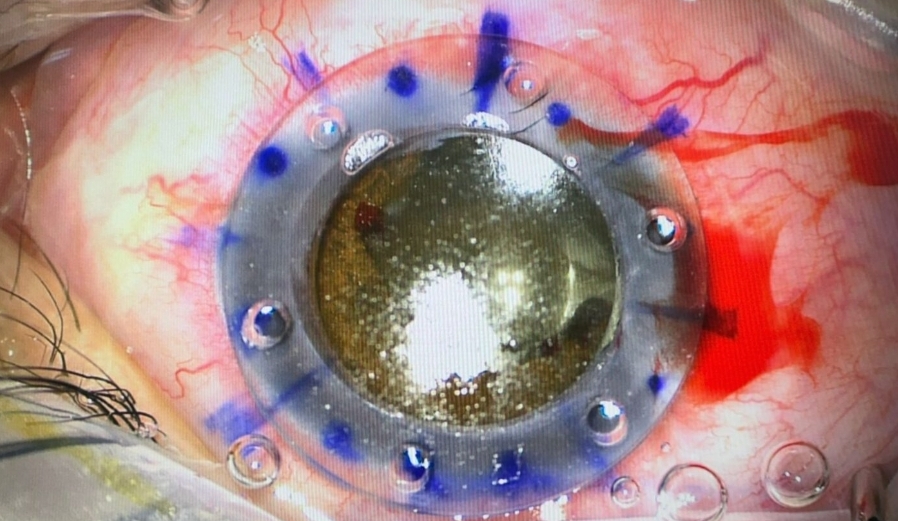 عملية نوعية لمريض في مقلة العين بمستشفى الملك المؤسس