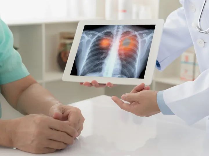 دراسة علمية أمريكية: جراحات سرطان الرئة ممكنة لمن هم فوق عمر 80 عاما