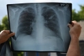 دراسة بريطانية: ثلاثة أنماط بيولوجية مختلفة للالتهاب الرئوي قد تفسّر تفاوت فرص النجاة